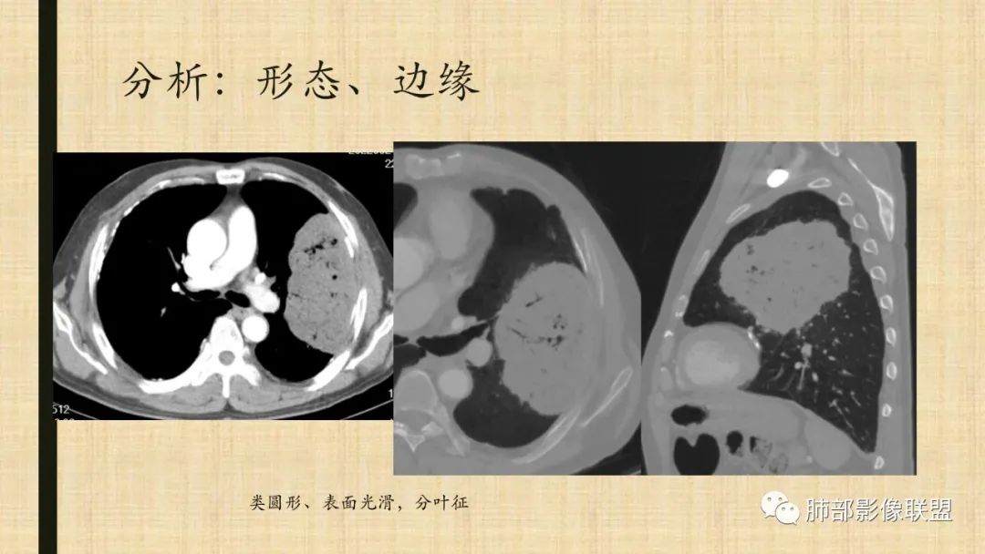 【病例】肺部硕大块影一定想到它！-78