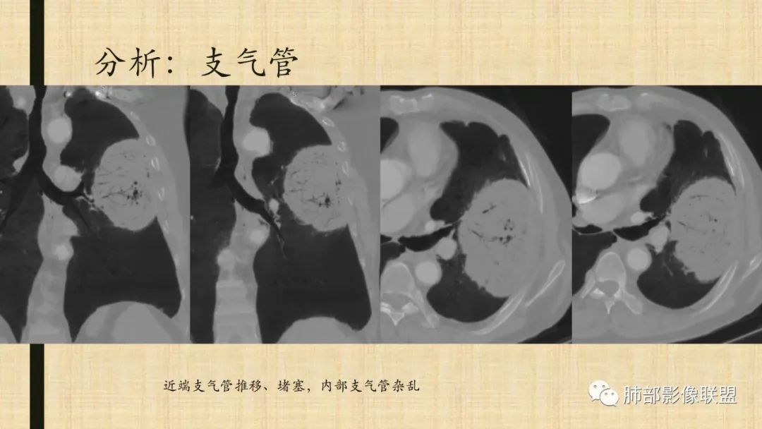 【病例】肺部硕大块影一定想到它！-79