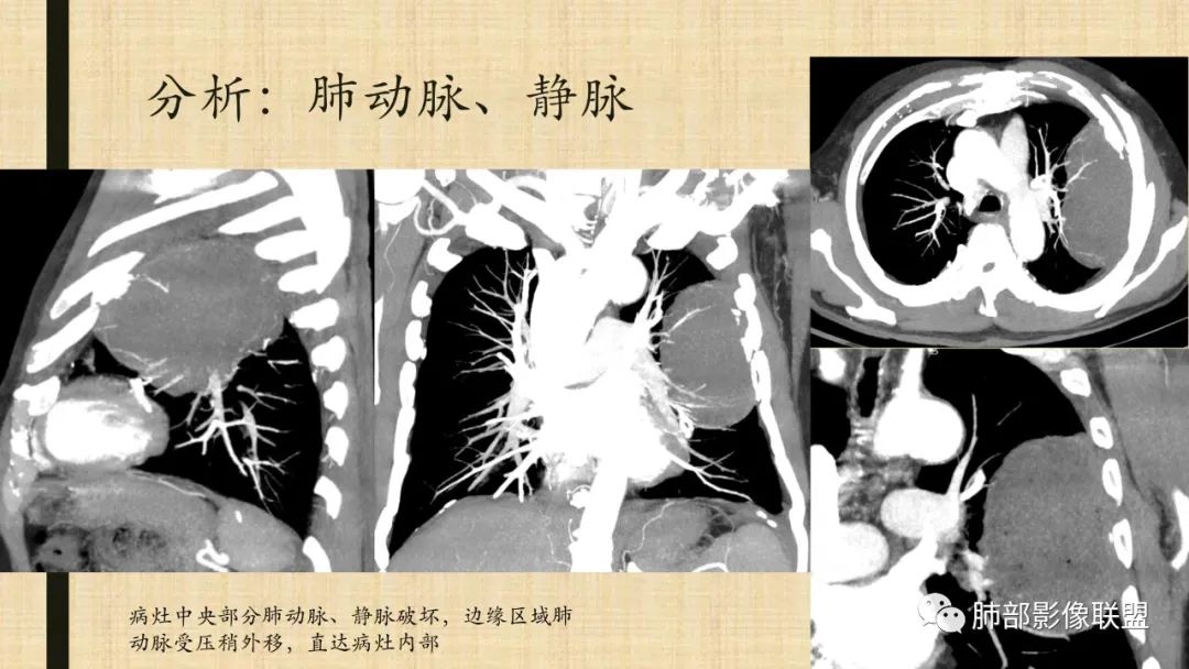 【病例】肺部硕大块影一定想到它！-80