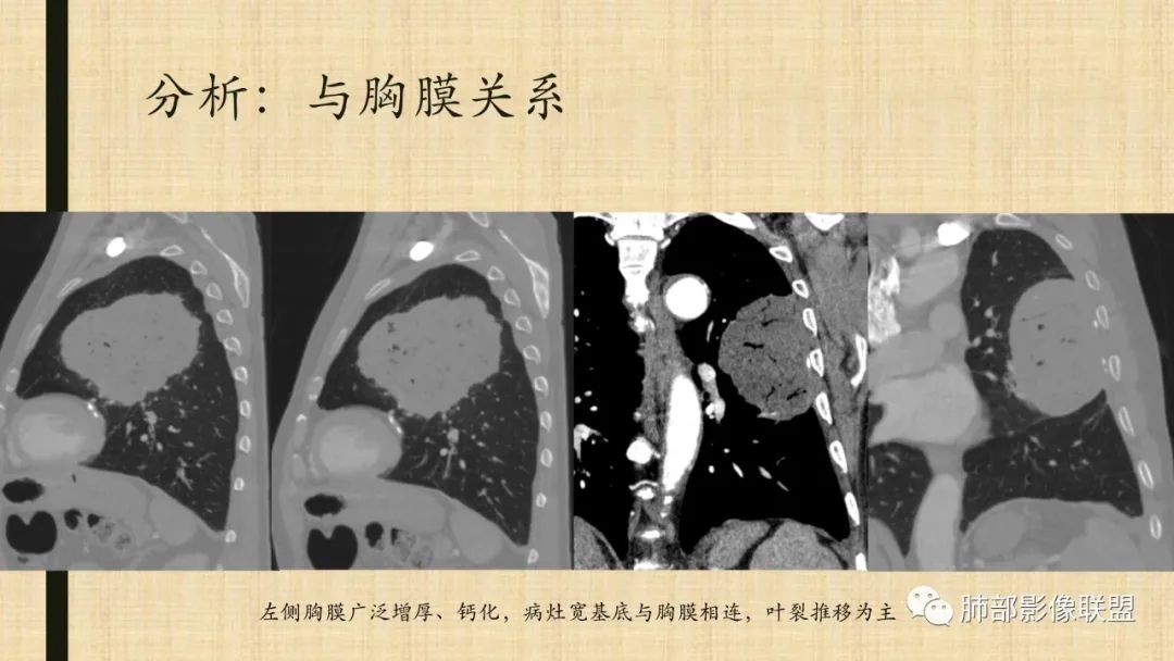 【病例】肺部硕大块影一定想到它！-81