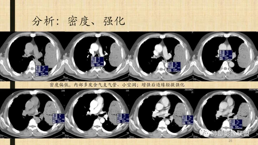 【病例】肺部硕大块影一定想到它！-82