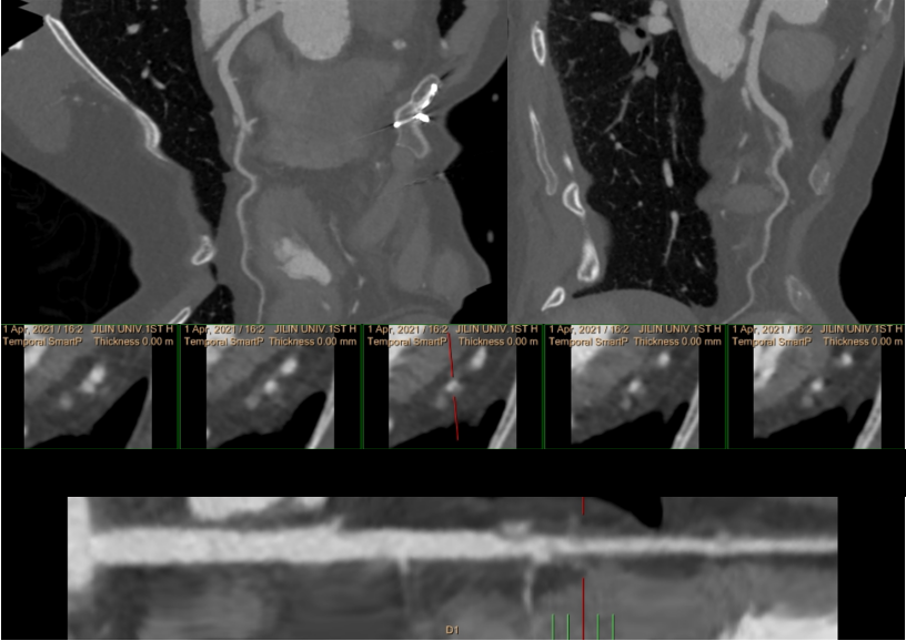 少见的急症—冠状动脉夹层-3 少见的急症—冠状动脉夹层-3