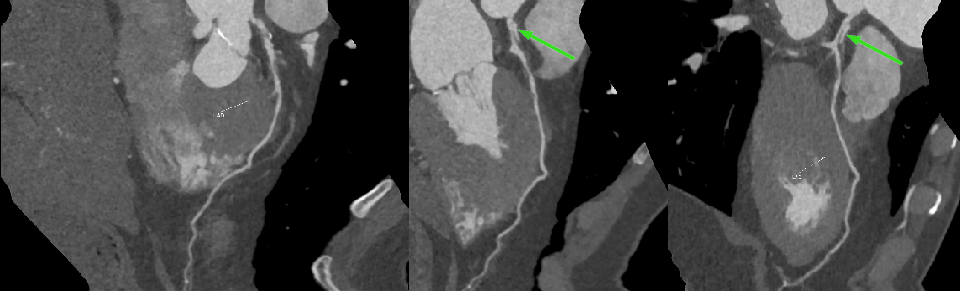 少见的急症—冠状动脉夹层-5 少见的急症—冠状动脉夹层-5