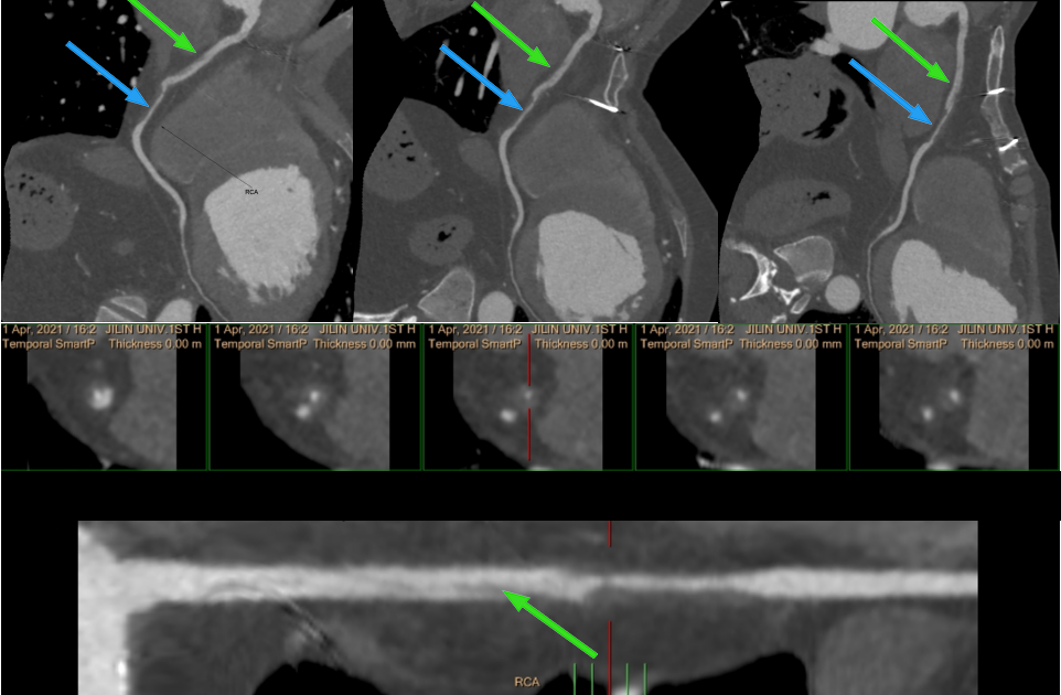 少见的急症—冠状动脉夹层-2 少见的急症—冠状动脉夹层-2