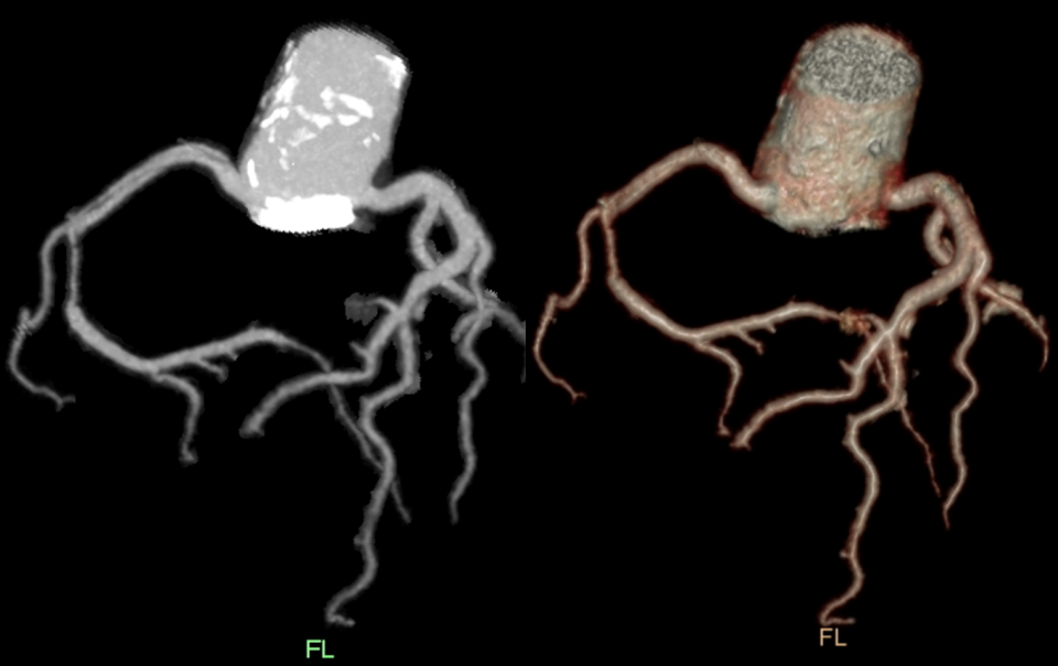 少见的急症—冠状动脉夹层-4 少见的急症—冠状动脉夹层-4