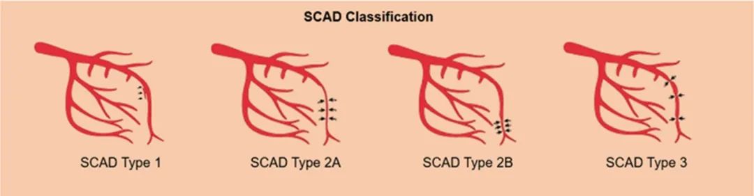 少见的急症—冠状动脉夹层-7 少见的急症—冠状动脉夹层-7