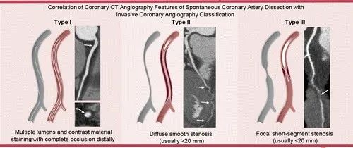 少见的急症—冠状动脉夹层-8 少见的急症—冠状动脉夹层-8