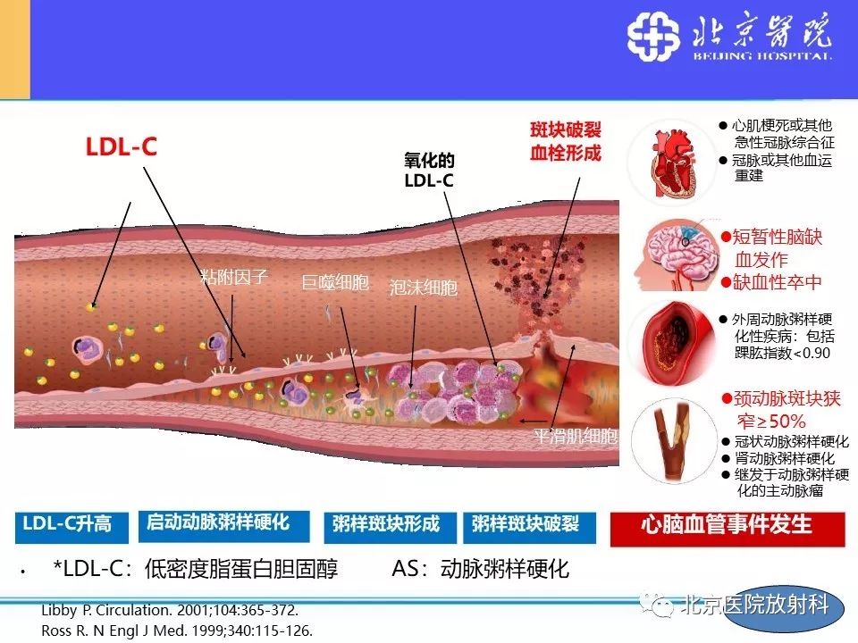 【PPT】HRMRI在缺血性脑卒中精准病因诊断中的应用-4
