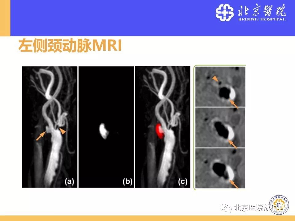 【PPT】HRMRI在缺血性脑卒中精准病因诊断中的应用-7