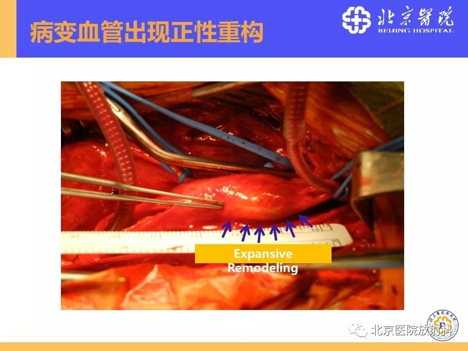 【PPT】HRMRI在缺血性脑卒中精准病因诊断中的应用-8