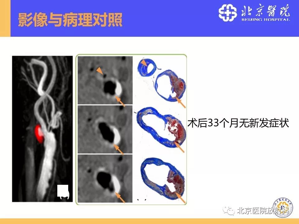 【PPT】HRMRI在缺血性脑卒中精准病因诊断中的应用-9