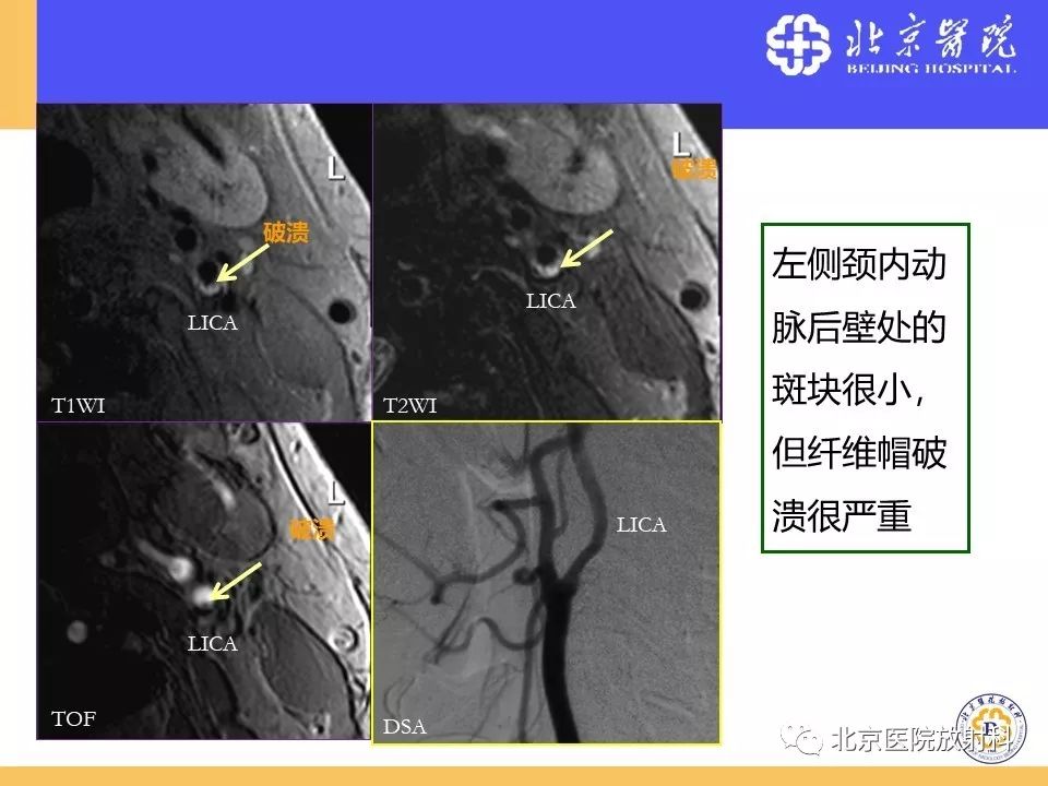 【PPT】HRMRI在缺血性脑卒中精准病因诊断中的应用-11