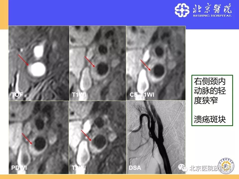 【PPT】HRMRI在缺血性脑卒中精准病因诊断中的应用-13