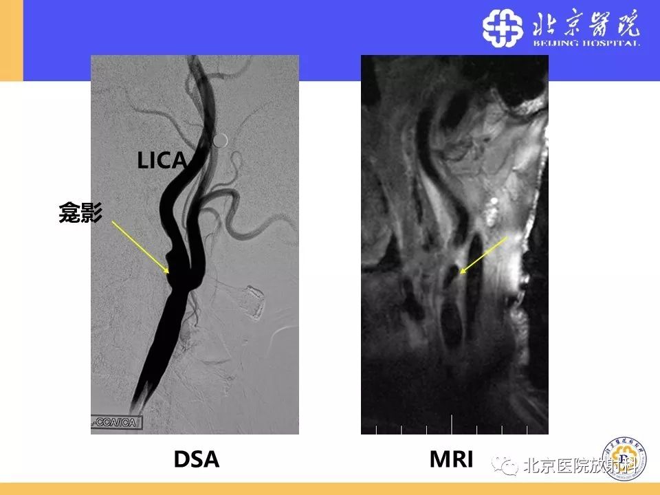 【PPT】HRMRI在缺血性脑卒中精准病因诊断中的应用-15
