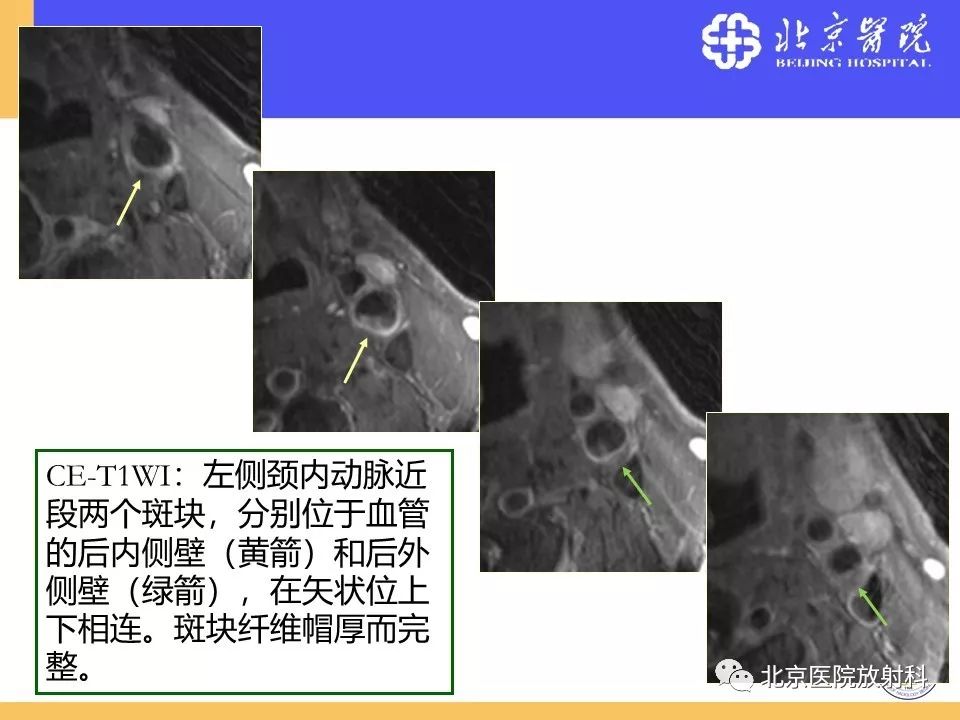 【PPT】HRMRI在缺血性脑卒中精准病因诊断中的应用-16