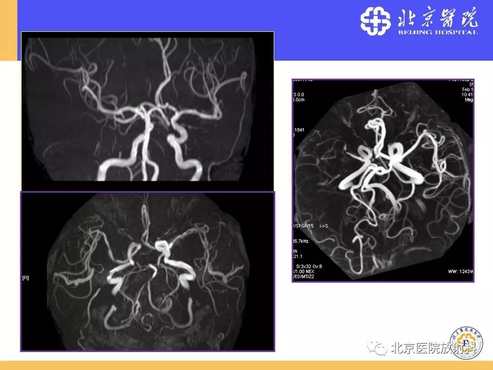 【PPT】HRMRI在缺血性脑卒中精准病因诊断中的应用-18
