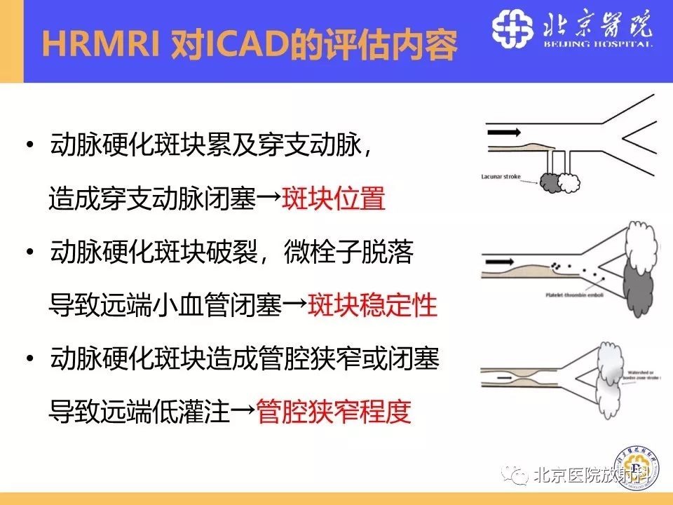 【PPT】HRMRI在缺血性脑卒中精准病因诊断中的应用-20