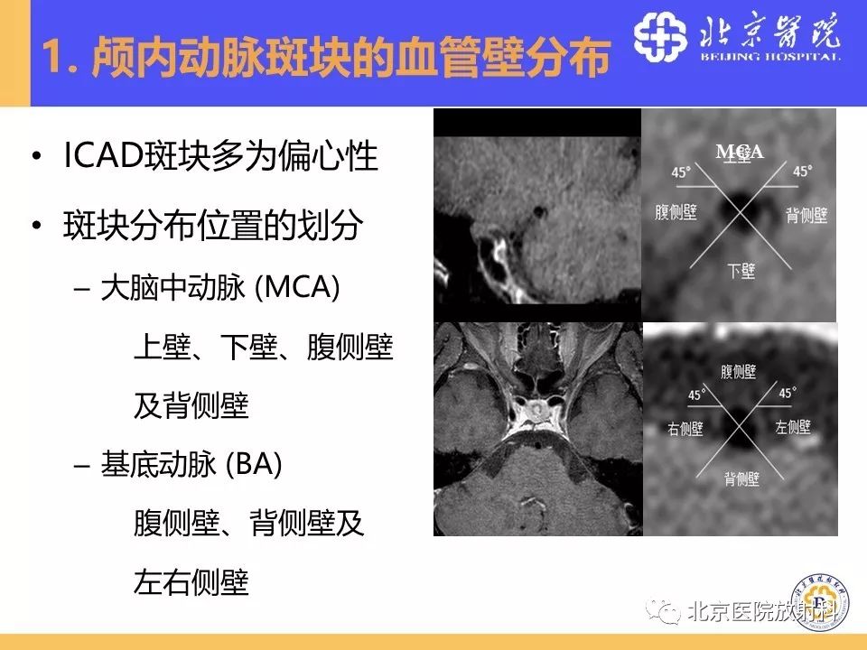 【PPT】HRMRI在缺血性脑卒中精准病因诊断中的应用-22