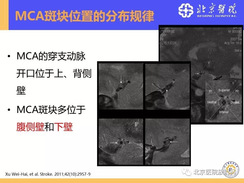 【PPT】HRMRI在缺血性脑卒中精准病因诊断中的应用-23