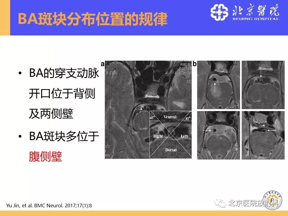【PPT】HRMRI在缺血性脑卒中精准病因诊断中的应用-24