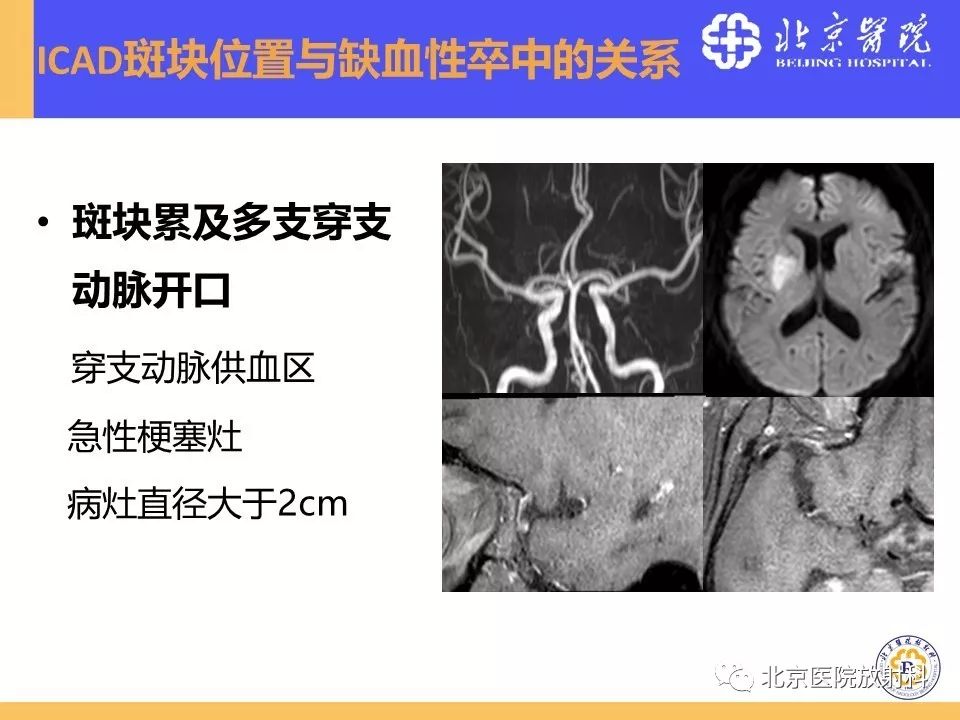 【PPT】HRMRI在缺血性脑卒中精准病因诊断中的应用-27