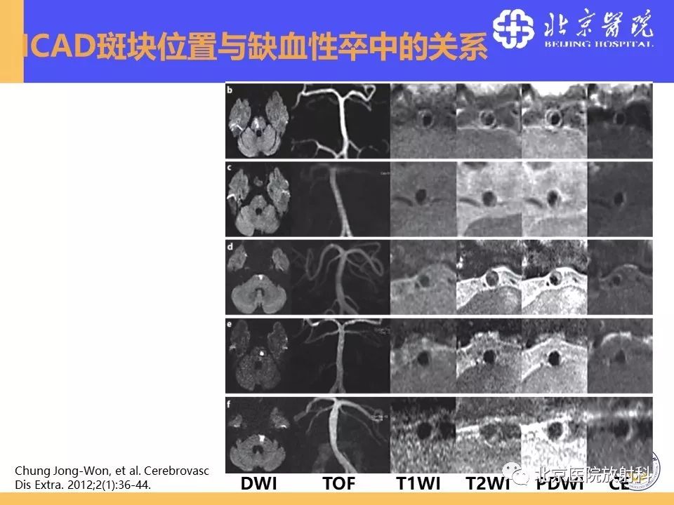 【PPT】HRMRI在缺血性脑卒中精准病因诊断中的应用-28