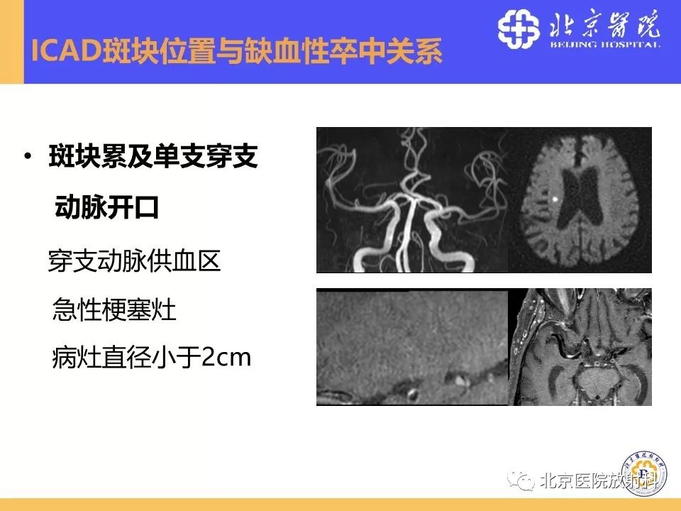 【PPT】HRMRI在缺血性脑卒中精准病因诊断中的应用-26
