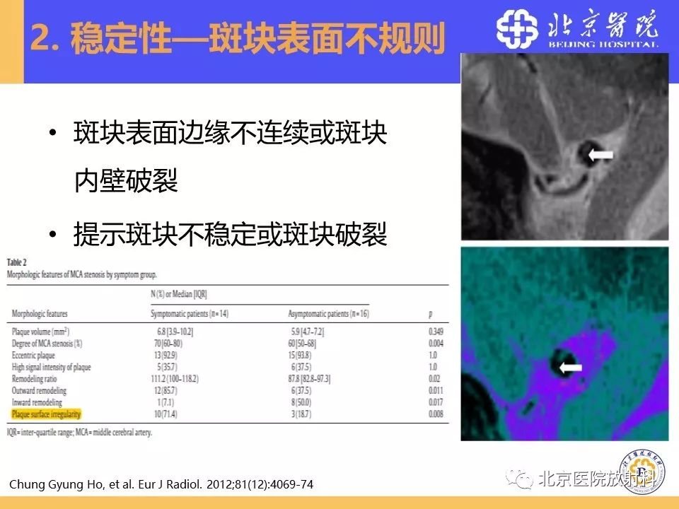 【PPT】HRMRI在缺血性脑卒中精准病因诊断中的应用-30