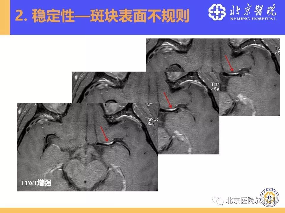 【PPT】HRMRI在缺血性脑卒中精准病因诊断中的应用-31