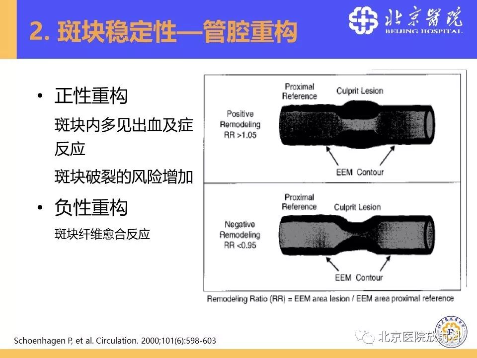 【PPT】HRMRI在缺血性脑卒中精准病因诊断中的应用-32