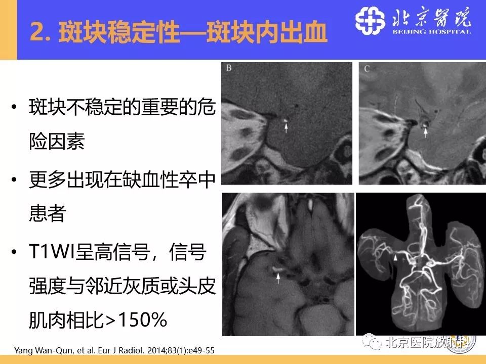 【PPT】HRMRI在缺血性脑卒中精准病因诊断中的应用-34