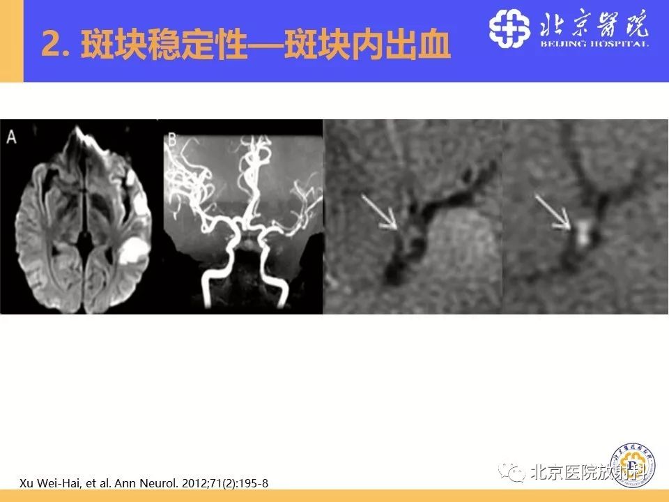 【PPT】HRMRI在缺血性脑卒中精准病因诊断中的应用-35
