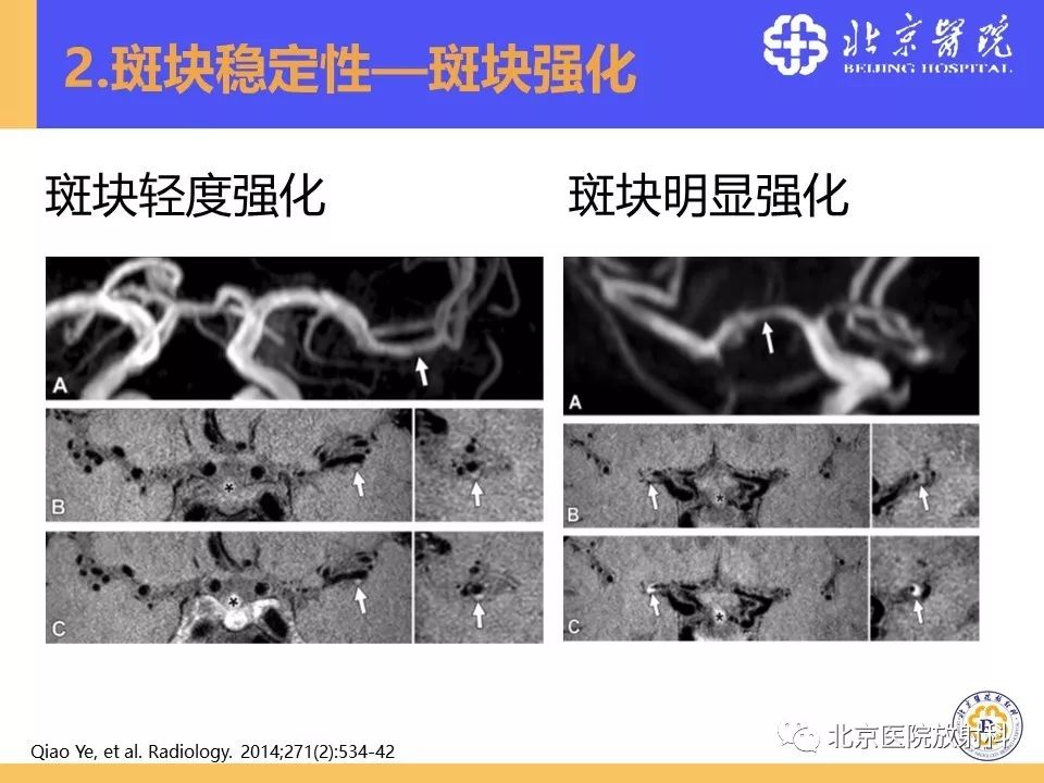 【PPT】HRMRI在缺血性脑卒中精准病因诊断中的应用-38