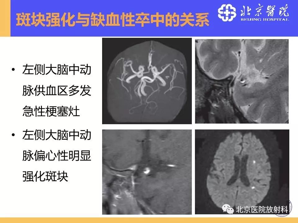 【PPT】HRMRI在缺血性脑卒中精准病因诊断中的应用-42