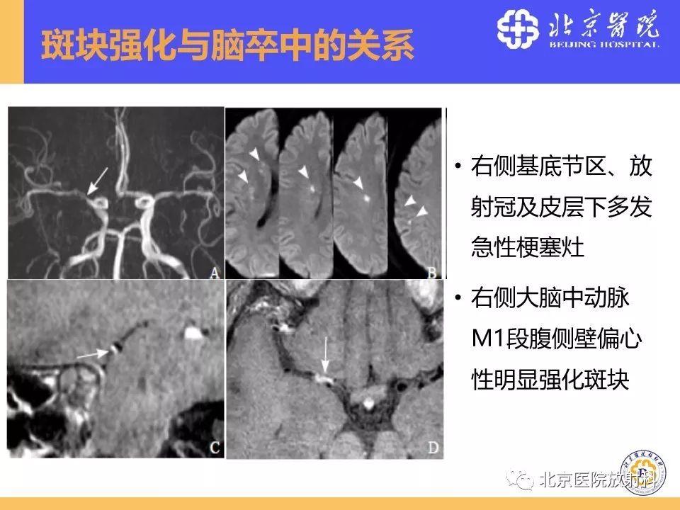 【PPT】HRMRI在缺血性脑卒中精准病因诊断中的应用-43