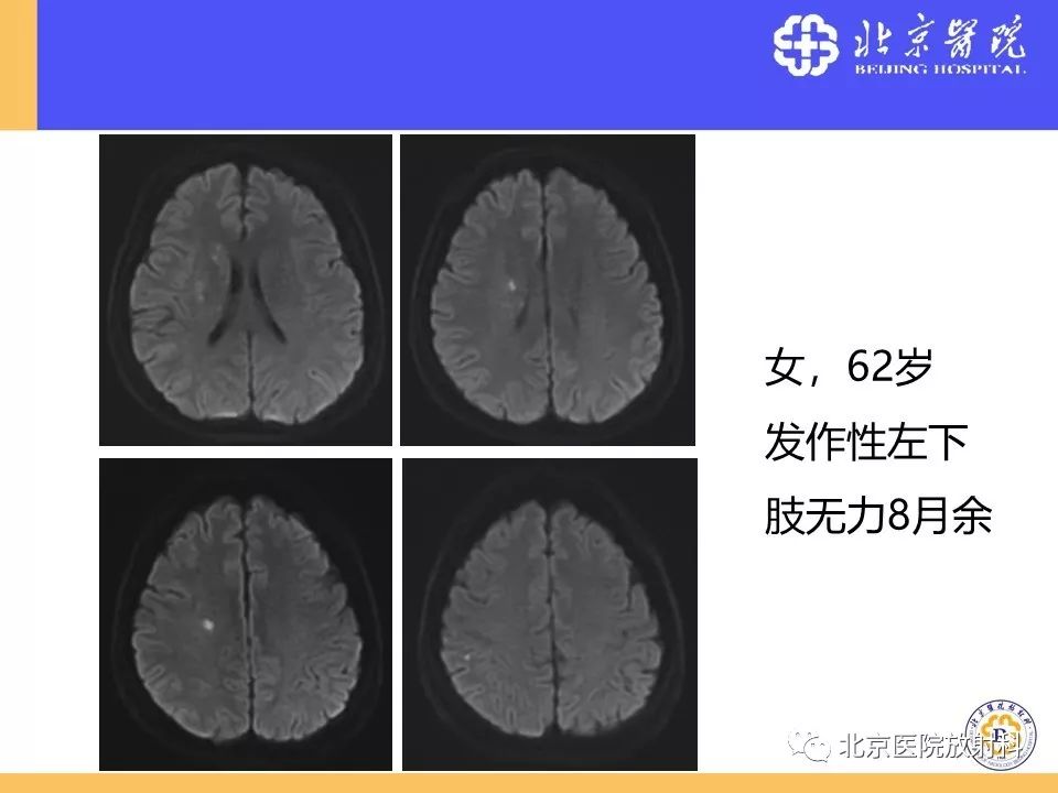 【PPT】HRMRI在缺血性脑卒中精准病因诊断中的应用-46