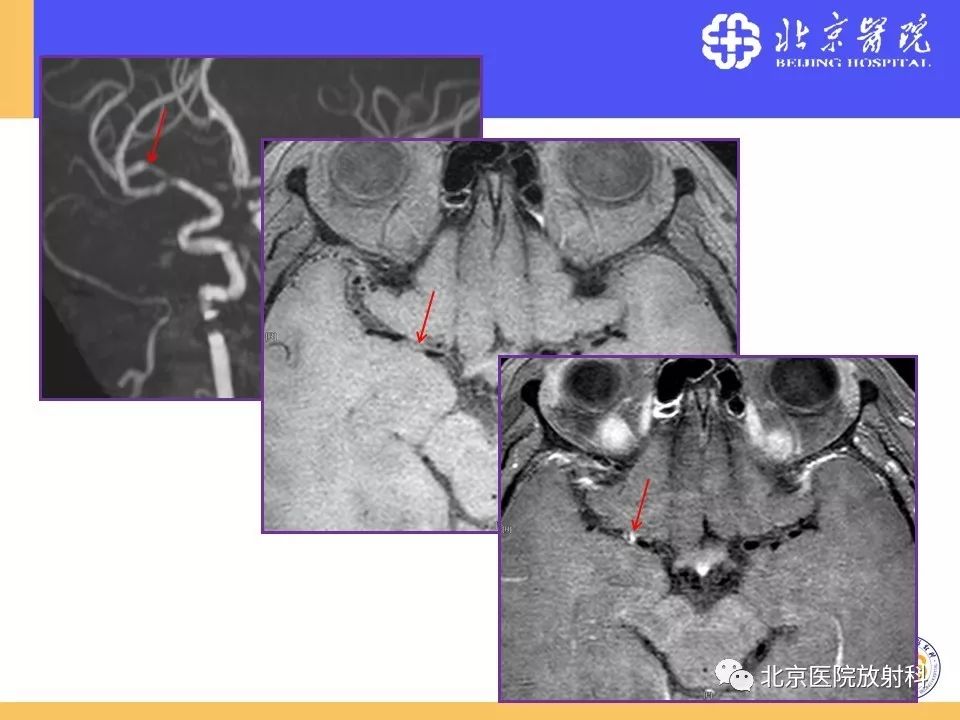 【PPT】HRMRI在缺血性脑卒中精准病因诊断中的应用-47