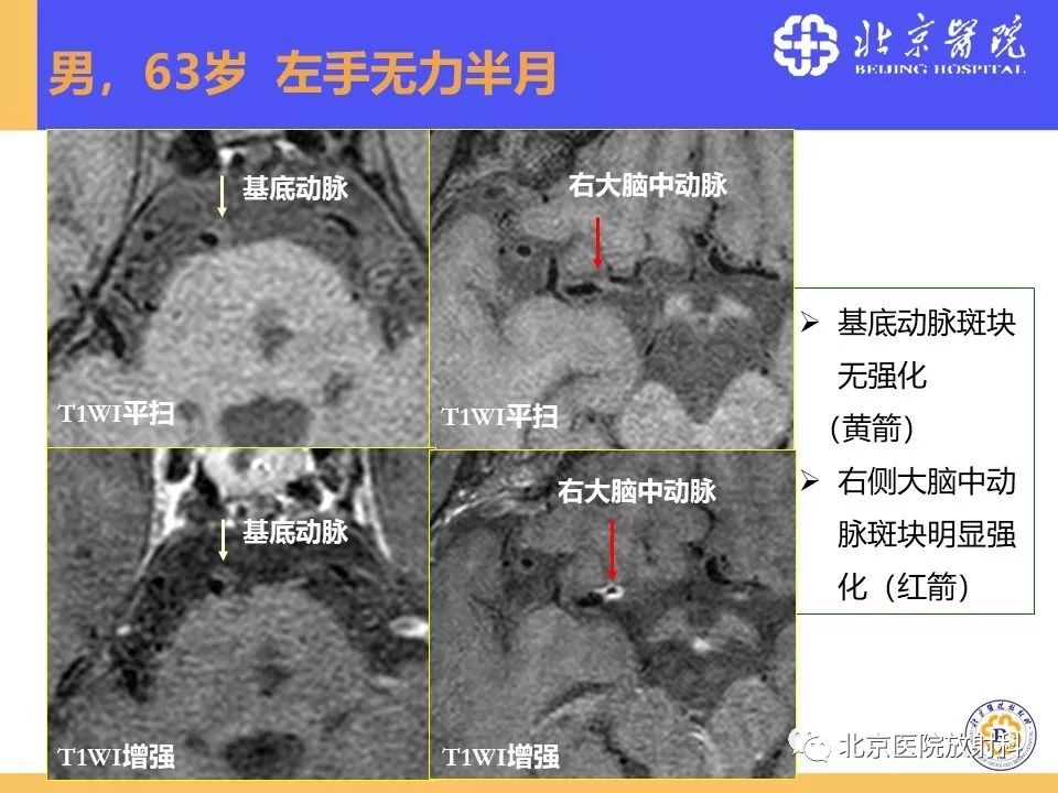 【PPT】HRMRI在缺血性脑卒中精准病因诊断中的应用-48