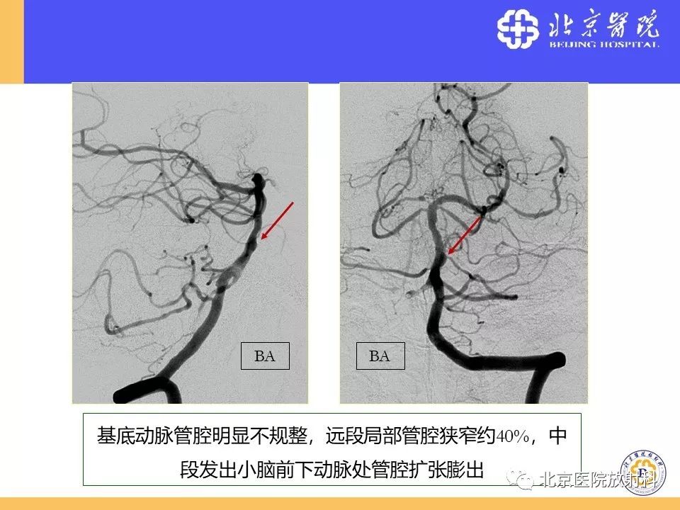 【PPT】HRMRI在缺血性脑卒中精准病因诊断中的应用-50