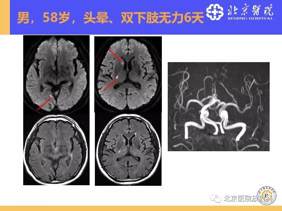 【PPT】HRMRI在缺血性脑卒中精准病因诊断中的应用-53