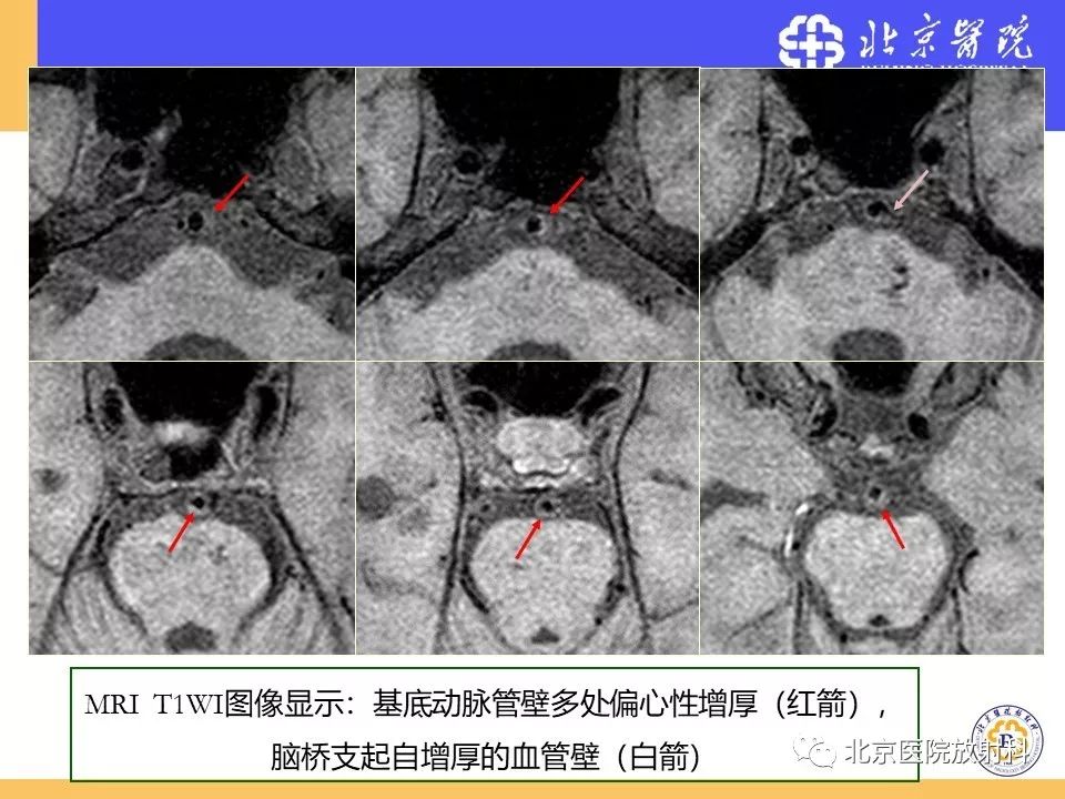 【PPT】HRMRI在缺血性脑卒中精准病因诊断中的应用-52