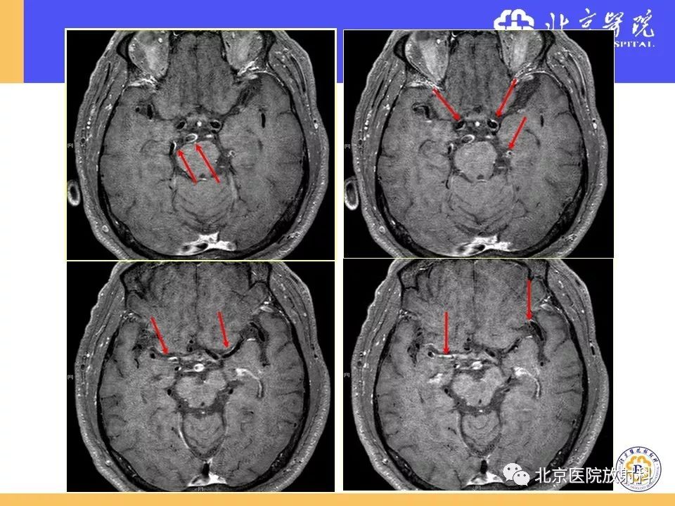 【PPT】HRMRI在缺血性脑卒中精准病因诊断中的应用-54