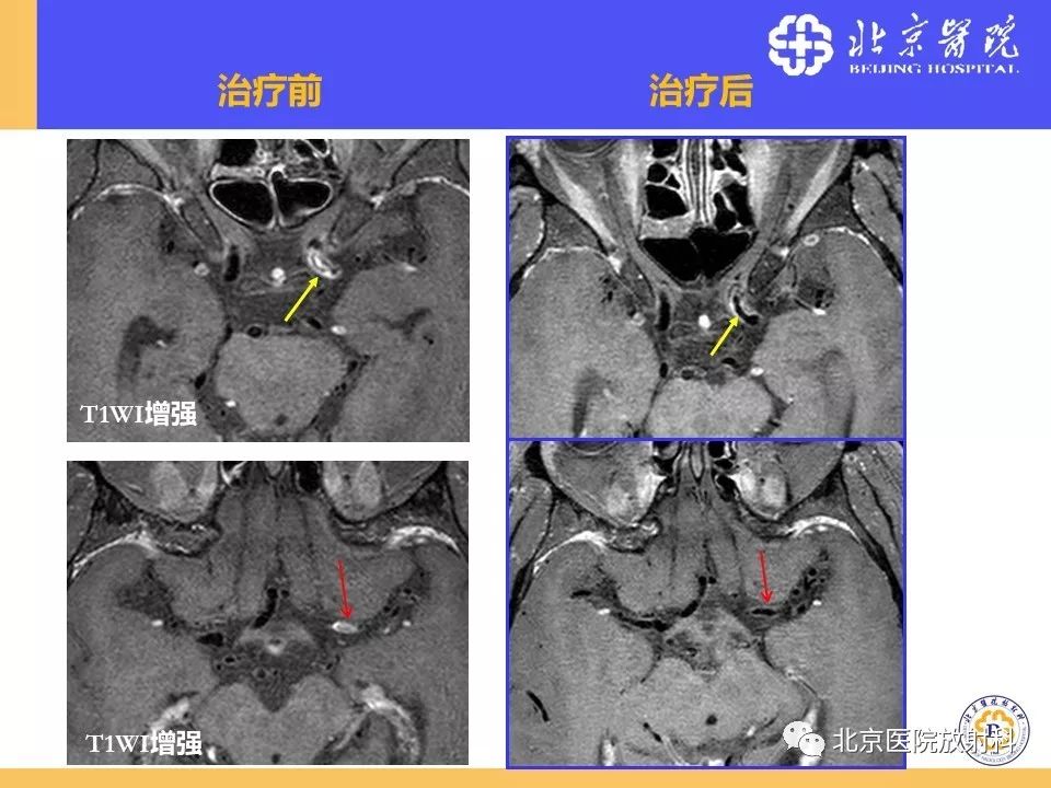【PPT】HRMRI在缺血性脑卒中精准病因诊断中的应用-58