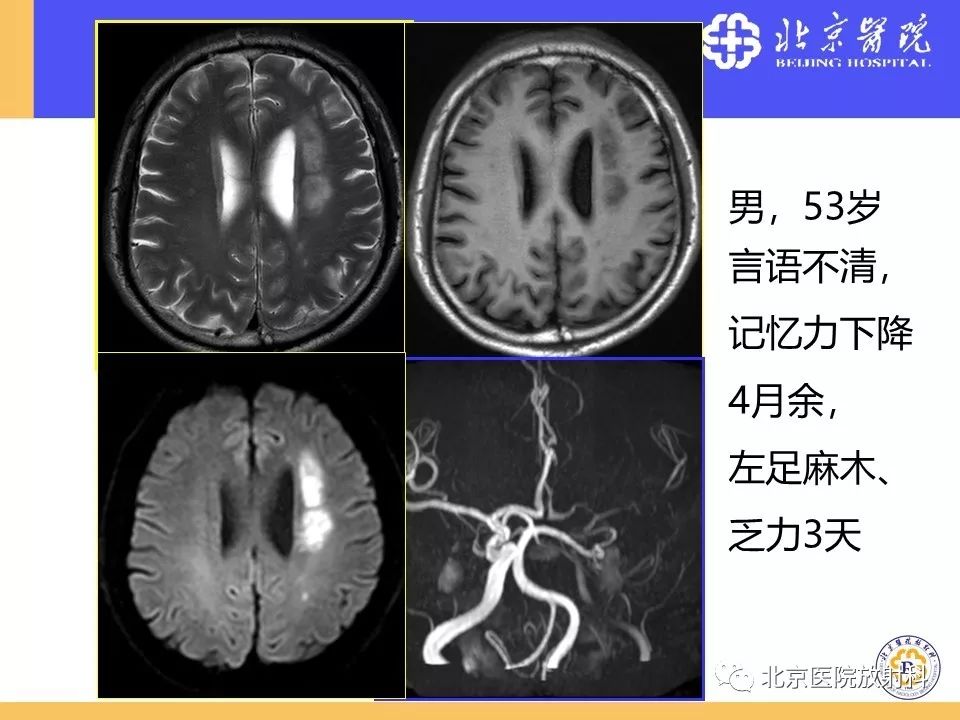 【PPT】HRMRI在缺血性脑卒中精准病因诊断中的应用-57