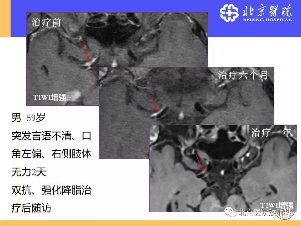 【PPT】HRMRI在缺血性脑卒中精准病因诊断中的应用-59
