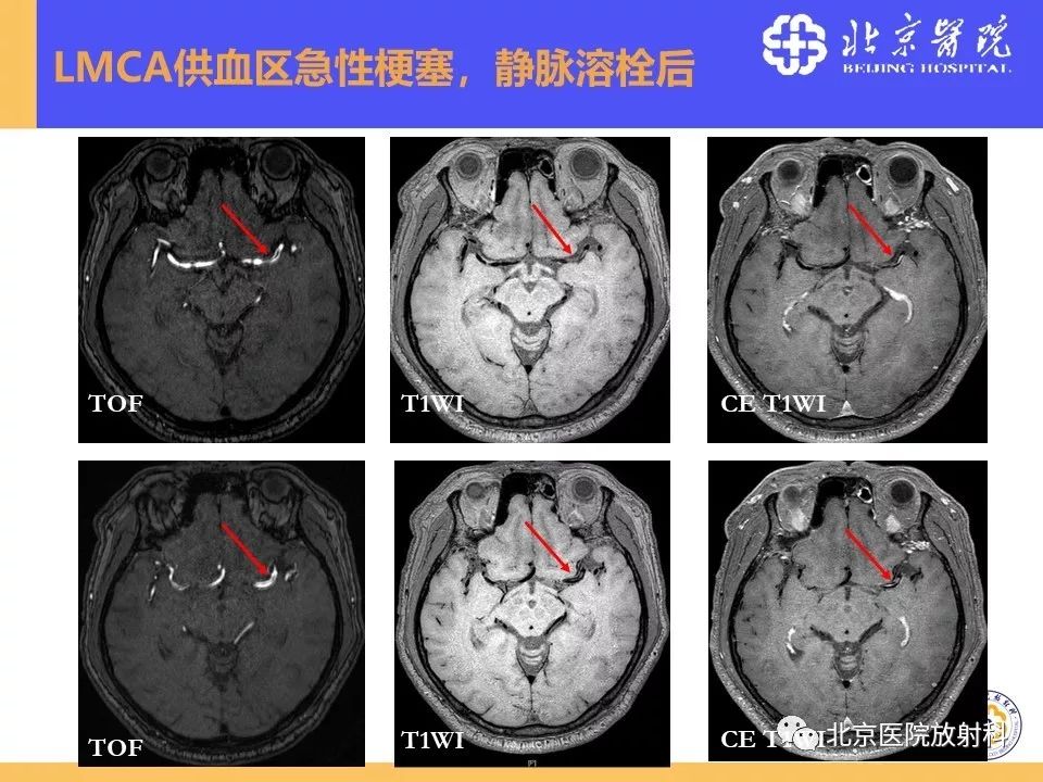 【PPT】HRMRI在缺血性脑卒中精准病因诊断中的应用-61