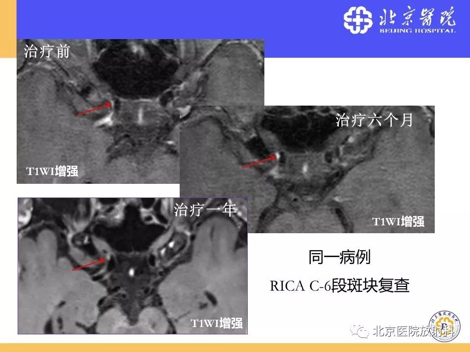 【PPT】HRMRI在缺血性脑卒中精准病因诊断中的应用-60