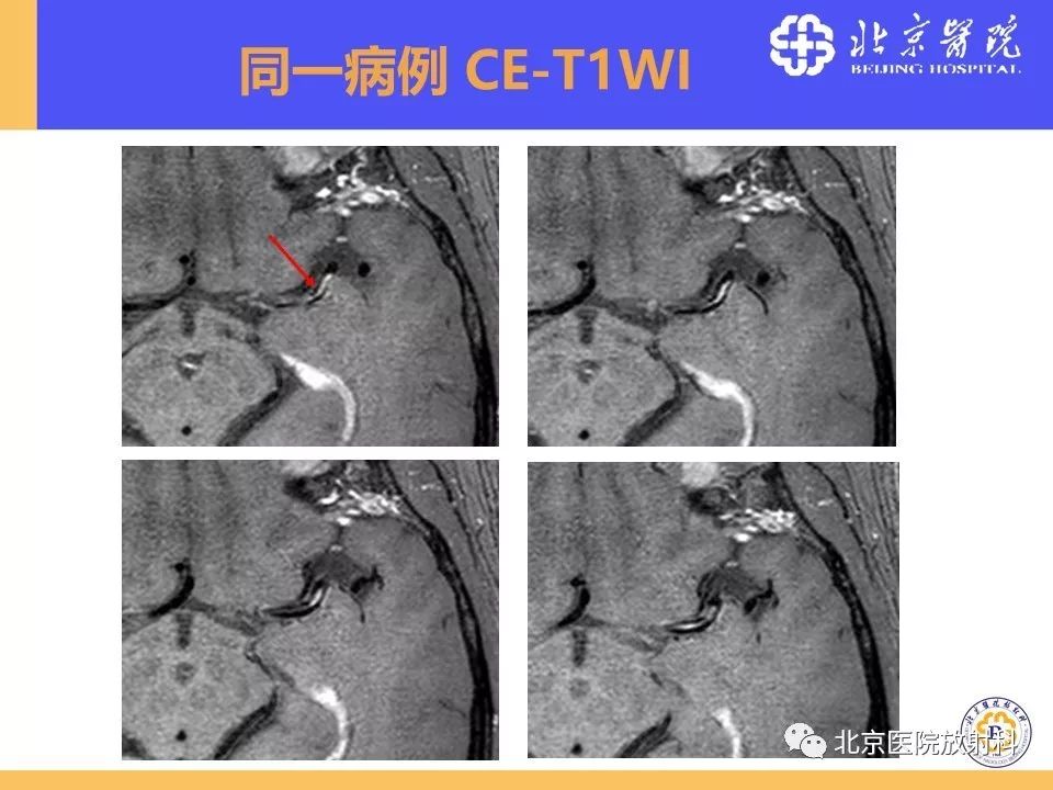 【PPT】HRMRI在缺血性脑卒中精准病因诊断中的应用-62