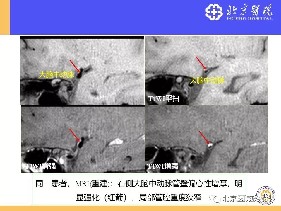 【PPT】HRMRI在缺血性脑卒中精准病因诊断中的应用-66