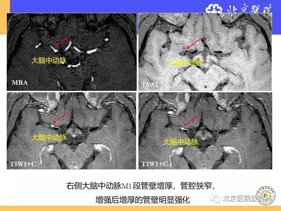【PPT】HRMRI在缺血性脑卒中精准病因诊断中的应用-65
